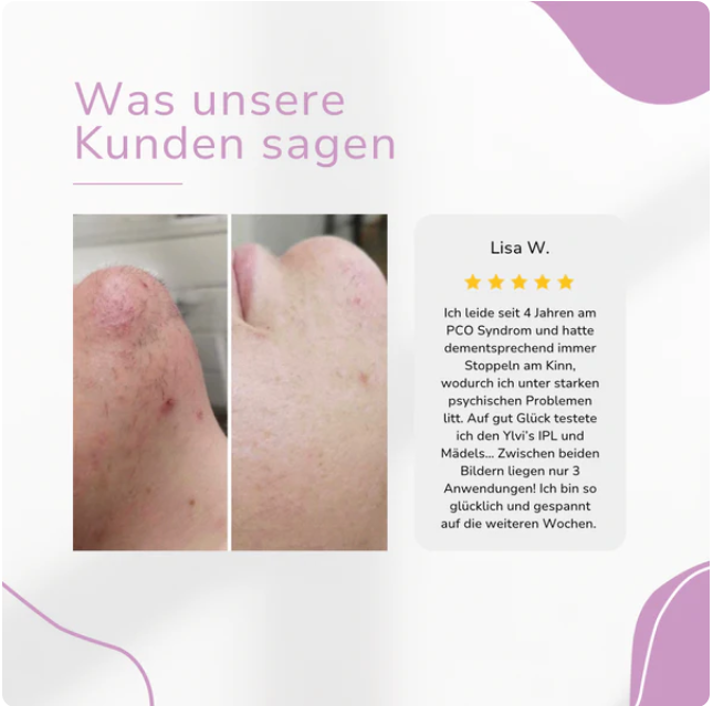 IPL Hair Remover | Die führende Laser-Haar-Entfernung für Zuhause
